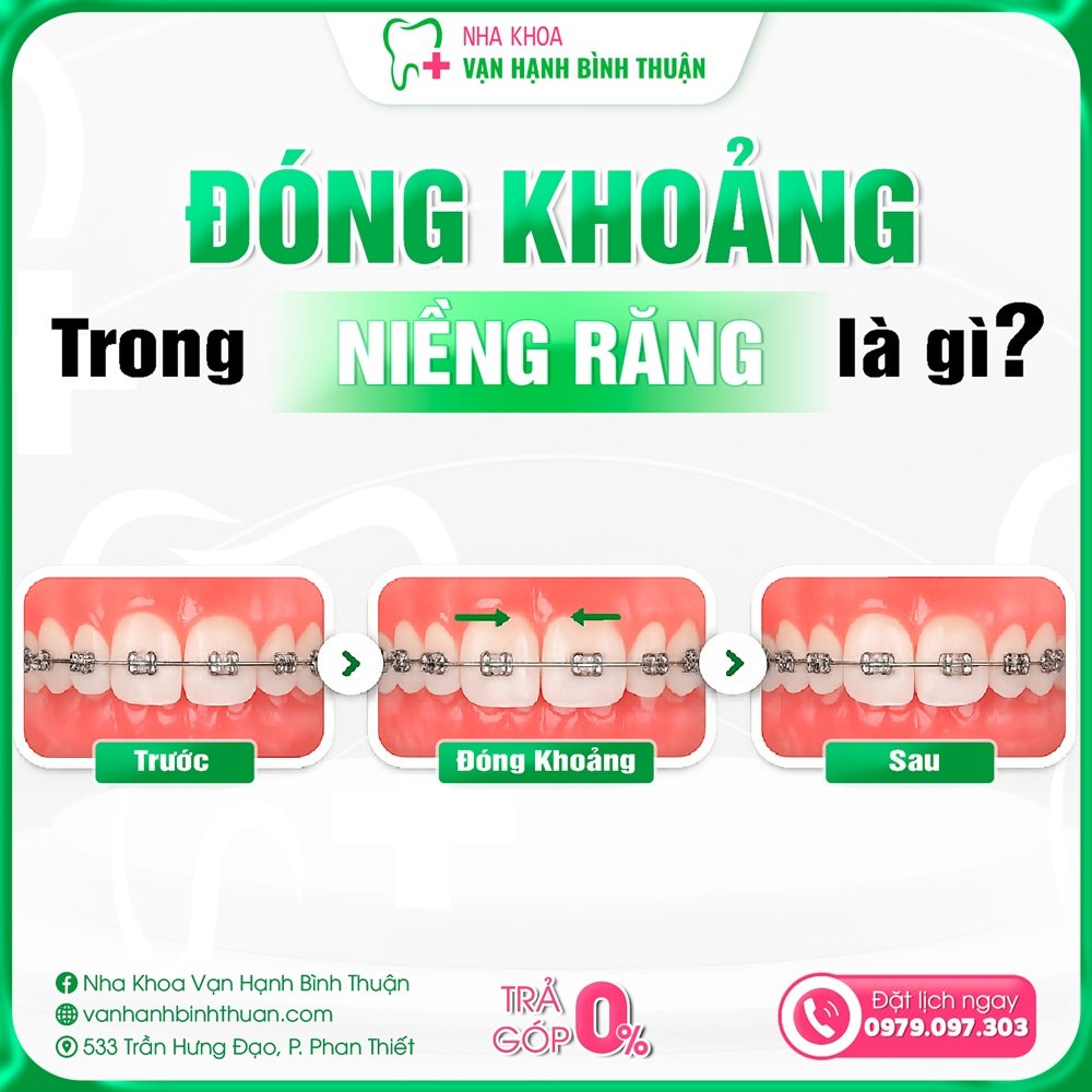 Đóng khoảng trong niềng răng là gì? Thời gian, phương pháp và các giai đoạn